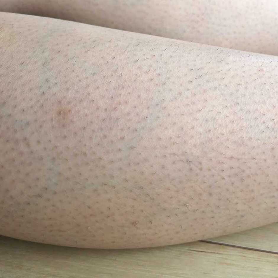 脱毛ケア始める前の状態