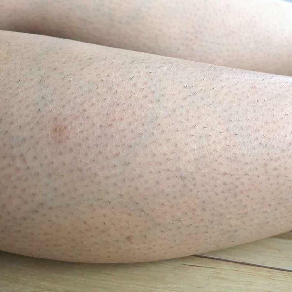 【効果の目安】パワーの強い家庭用脱毛器トリア4Xを使うとどうなる?