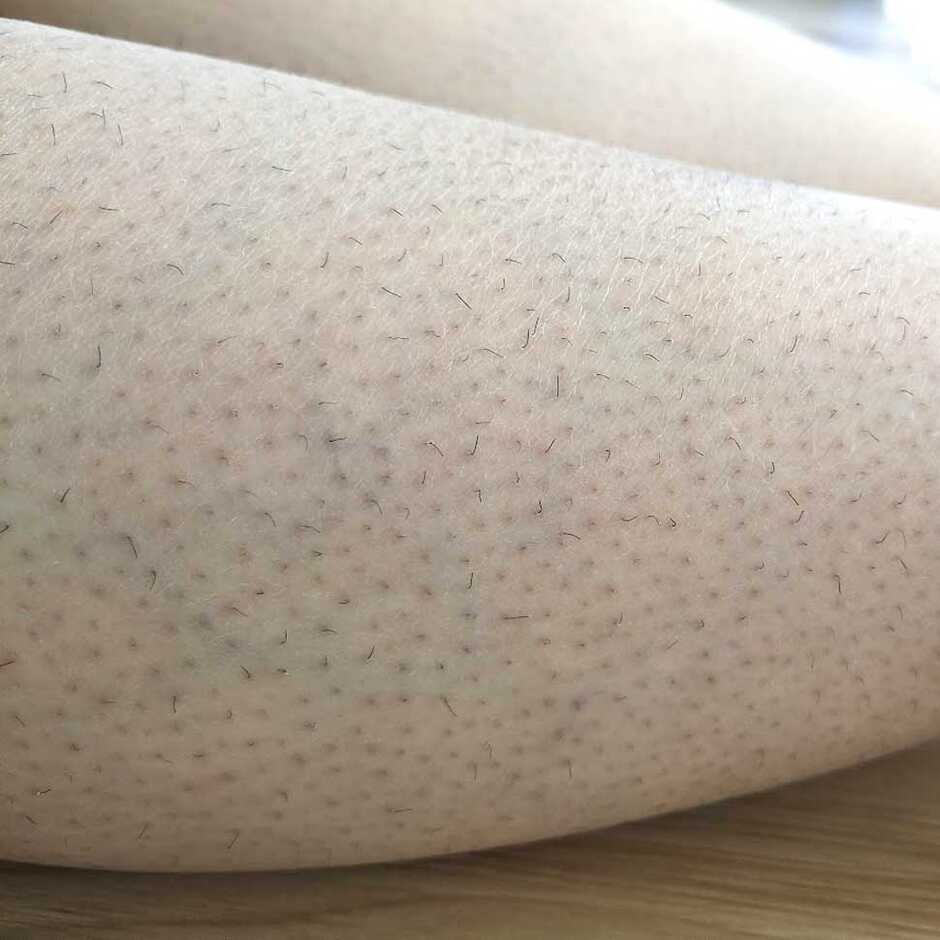 脱毛ケア始める前の状態
