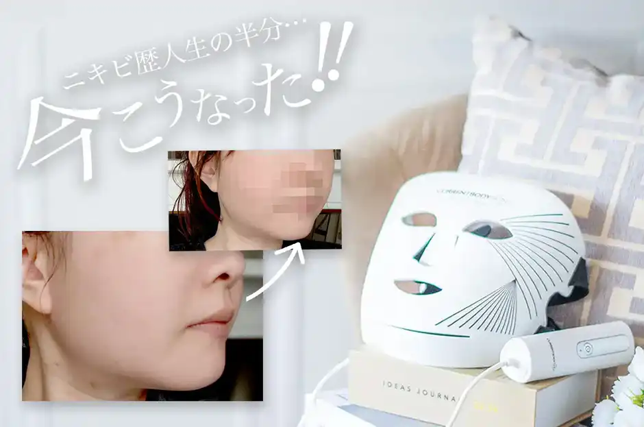 【人生の半分ニキビ肌】カレントボディLEDマスクで悩みが嘘みたいに解消した！