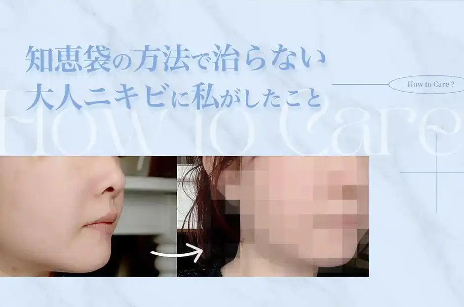 【実証写真あり】知恵袋の方法で治らない大人ニキビに私がしたこと
