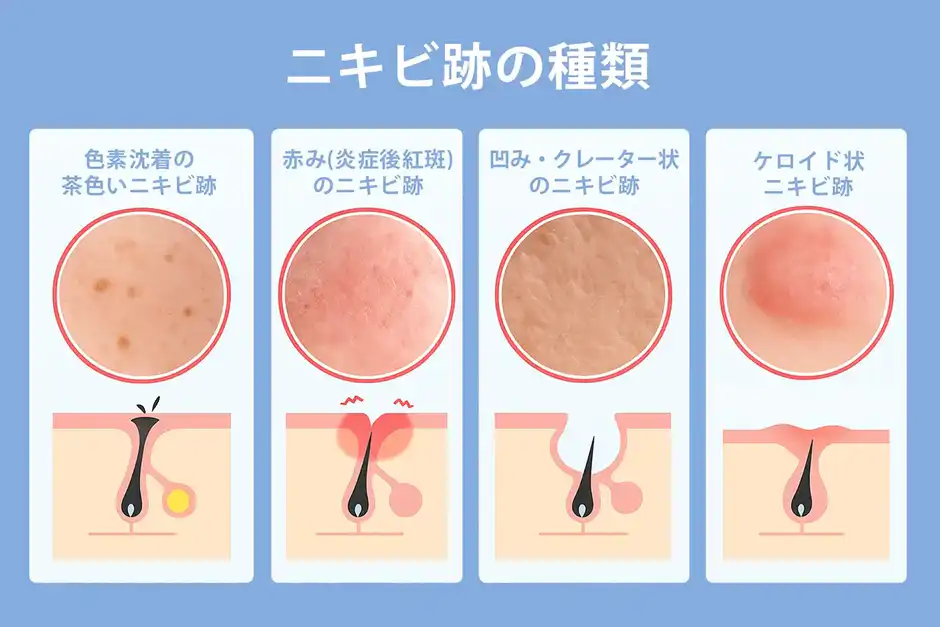 ニキビ跡の種類と特徴