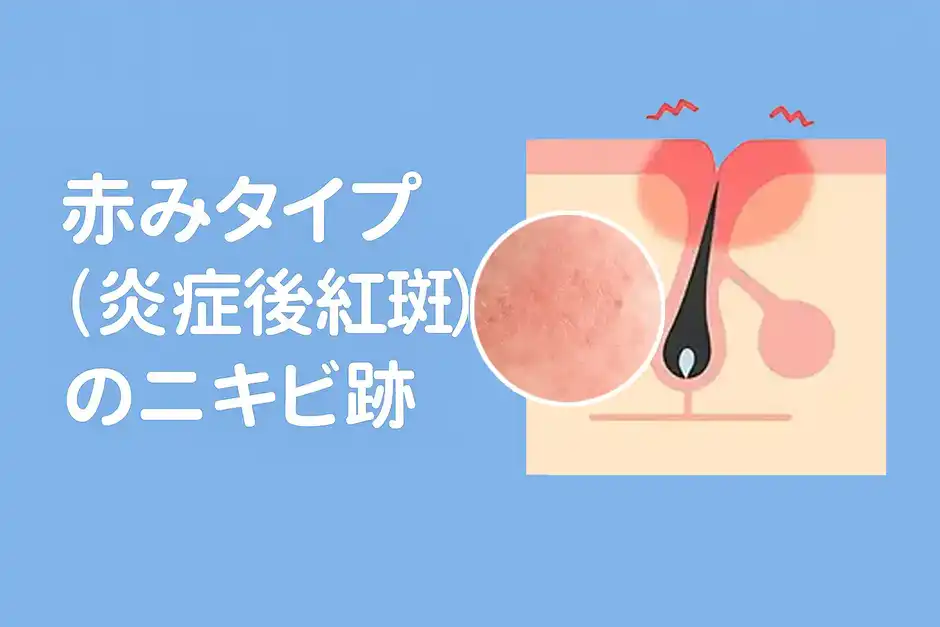 赤み(炎症後紅斑)のニキビ跡
