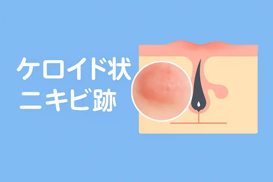 ケロイド状ニキビ跡