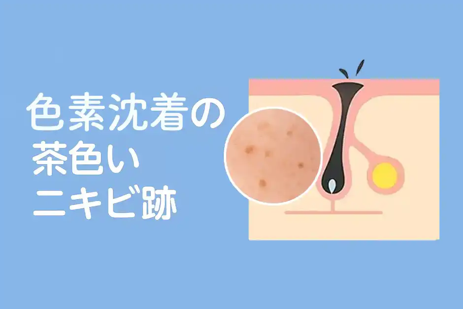 色素沈着の茶色いニキビ跡