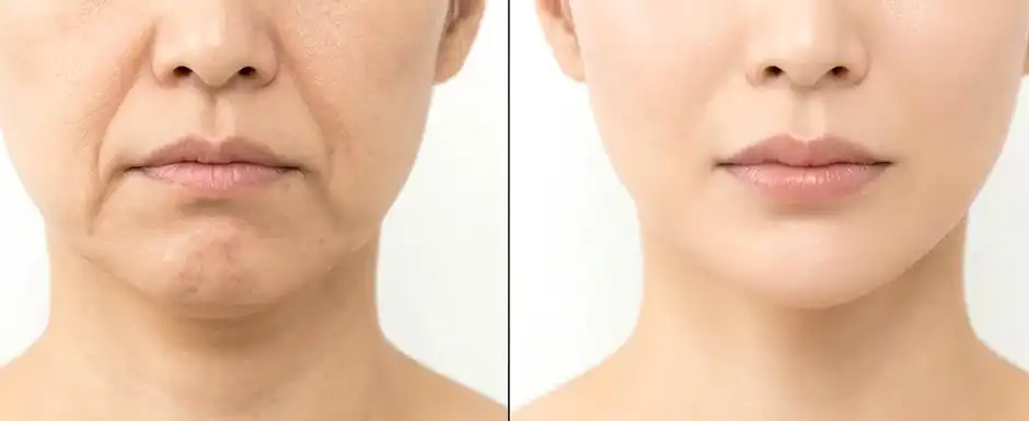 ほうれい線はシワではなく“たるみ”